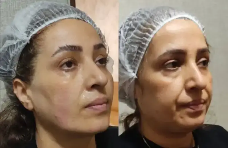 تصویر قبل و بعد از تزریق ژل به صورت