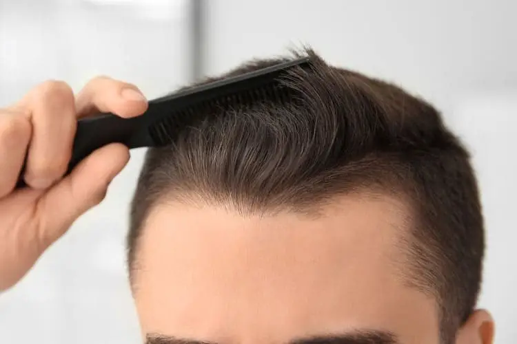 انواع روش های کاشت مو
