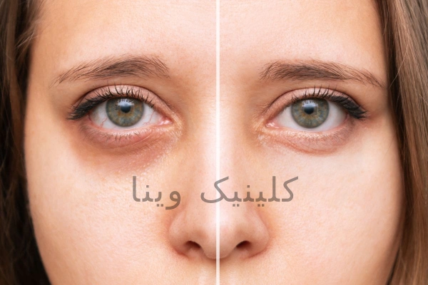 رفع سیاهی دور چشم
