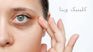 رفع سیاهی دور چشم