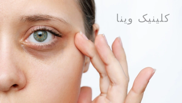 رفع سیاهی دور چشم