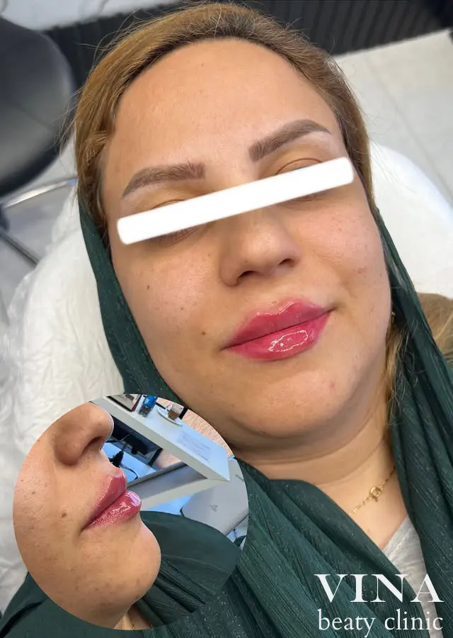 فیلر لب مدل روسی