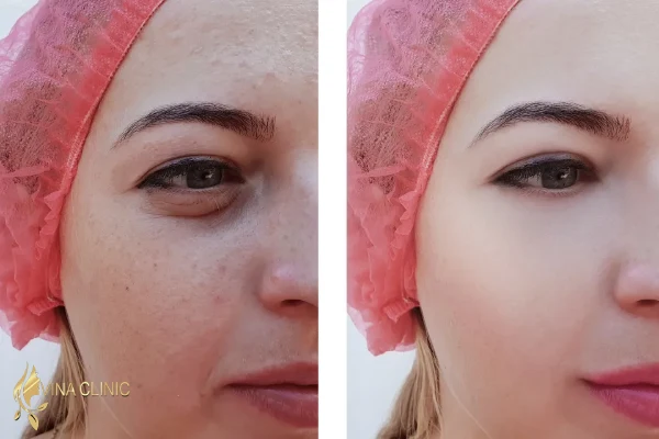 مزوتراپی صورت