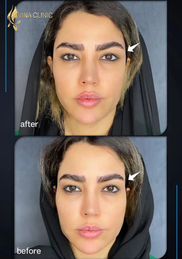 قبل و بعد تزریق فیلر شقیقه
