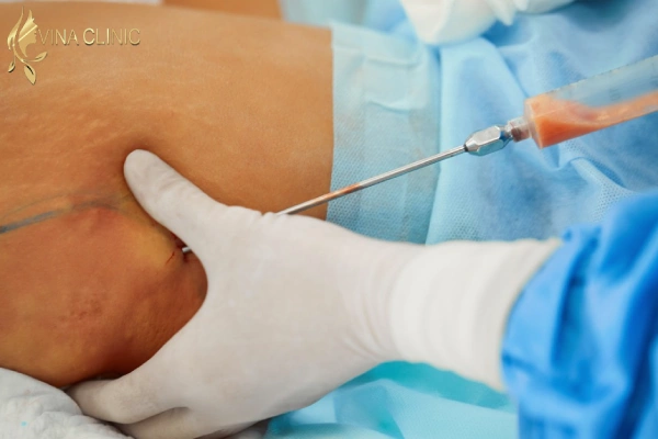 مراحل تزریق چربی